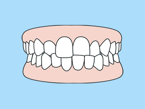 Crooked Teeth